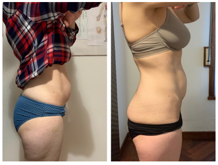 Antes y después caso clínico diástasis abdominal