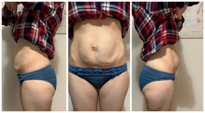 Valoración física de una diástasis abdominal Antes de tratamiento