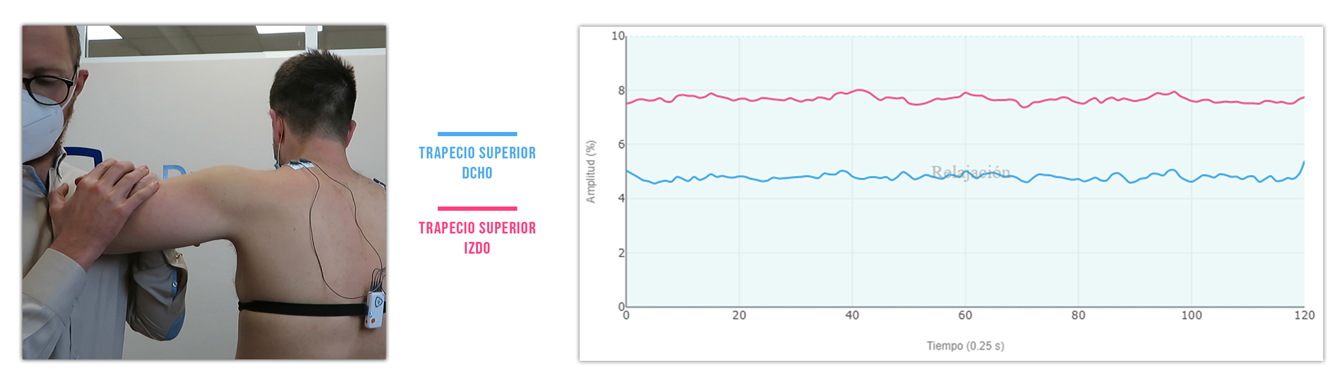 puntos gatillo (ejemplo trapecio) en el tono basal reposo