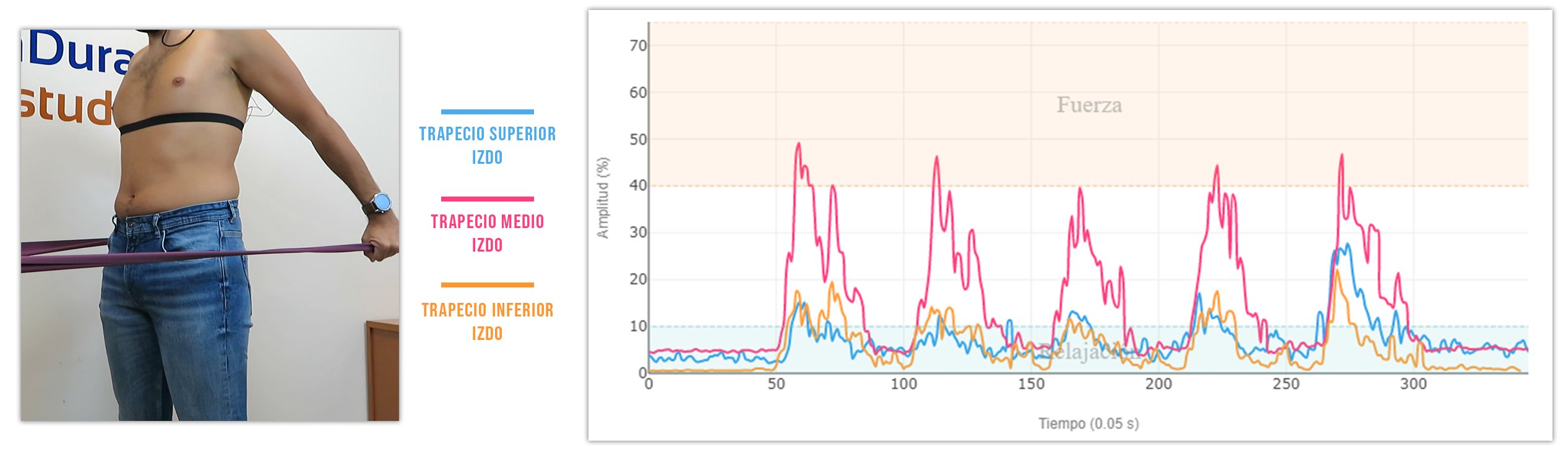 ejercicios de retracción escapular Remo con 0° de abducción del hombro y 0° de flexión del codo.