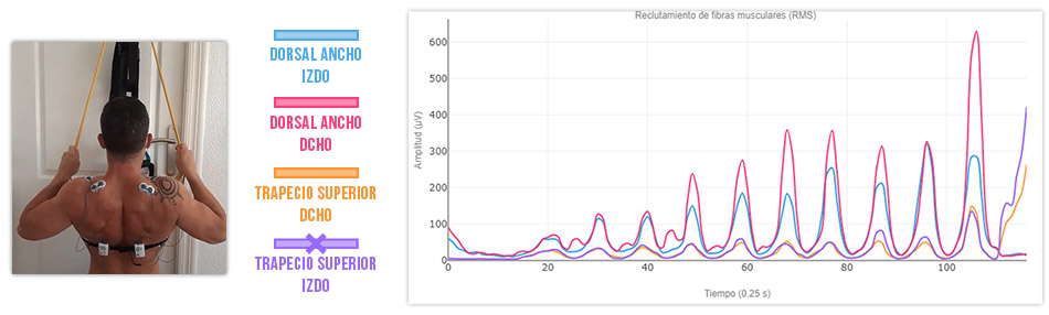 corrección inversión de sinergias en jalón al pecho