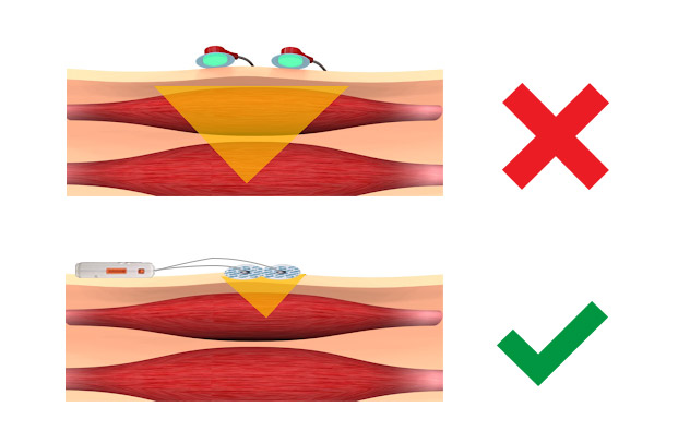 Cómo colocar los electrodos en la técnica de electromiografía