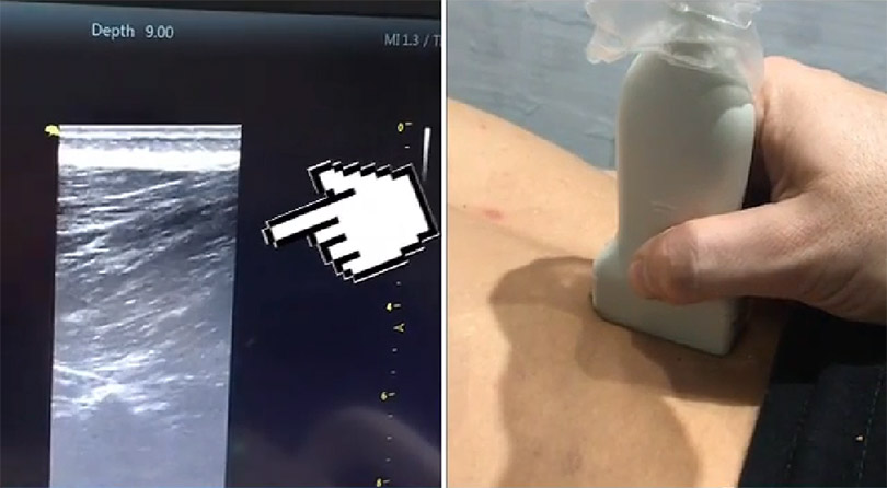 Eecografia del transverso del abdomen