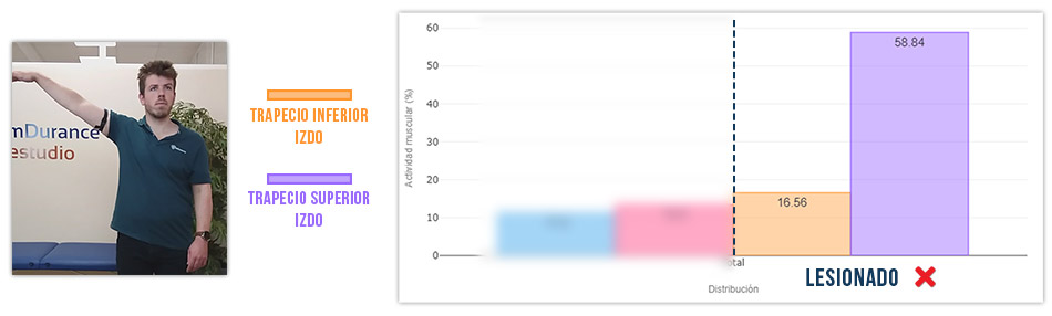 trapecio inferior vs trapecio superior abducción de hombro (mal)