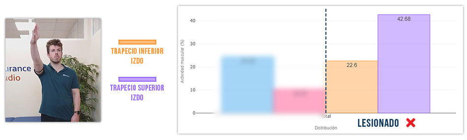 trapecio inferior vs trapecio superior flexión de hombro (mal)