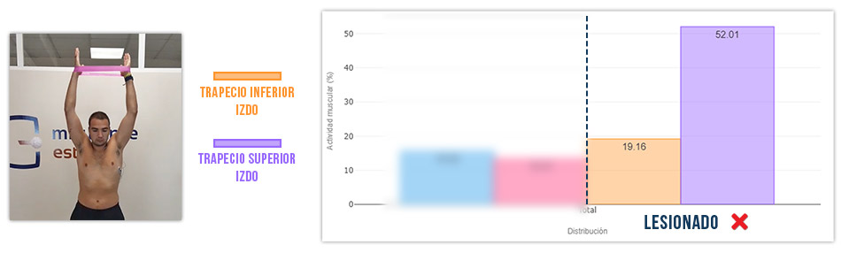 trapecio inferior vs trapecio superior press de hombro (mal)