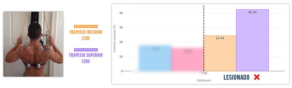 trapecio superior vs inferior en jalon al pecho mala sinergia