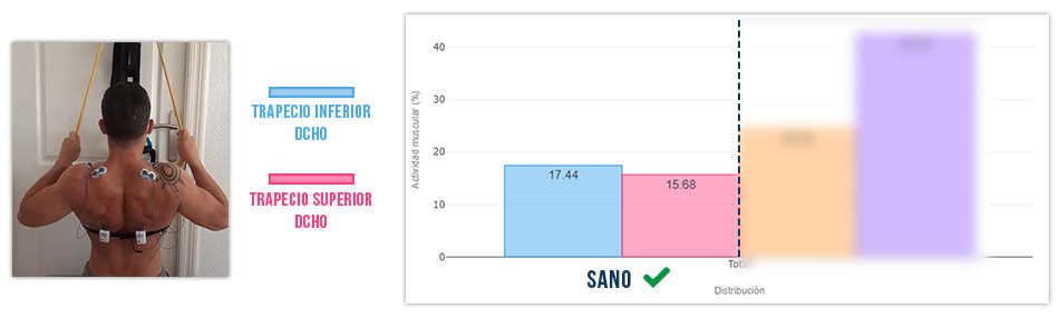 trapecio superior vs inferior en jalon al pecho buena sinergia