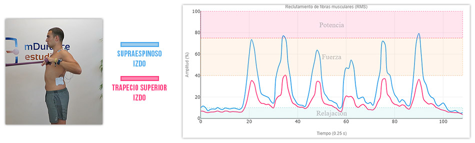 Variación 1 L activación del supraespinoso vs trapecio superior