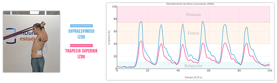Variación 2 L activación del supra vs trapecio superior
