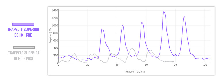 trapecio superior pre tratamiento vs post tratamiento