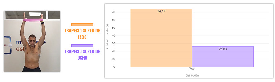 comparativa trapecio superior izquierdo con dererecho