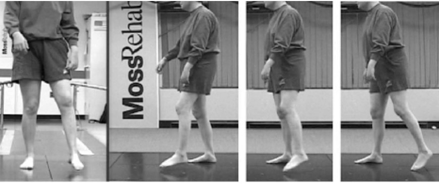 marcha con rodilla rígida