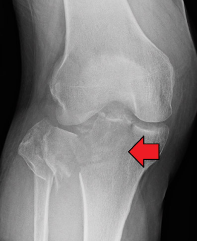 fractura en la meseta tibial