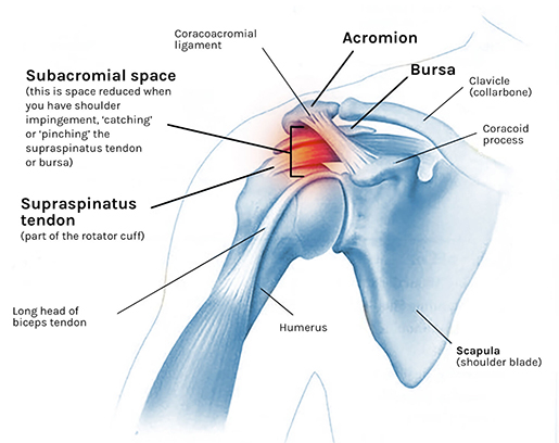 lesiones de impingement