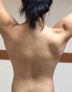 activación muscular escapular