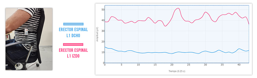 erector espinal izquierdo