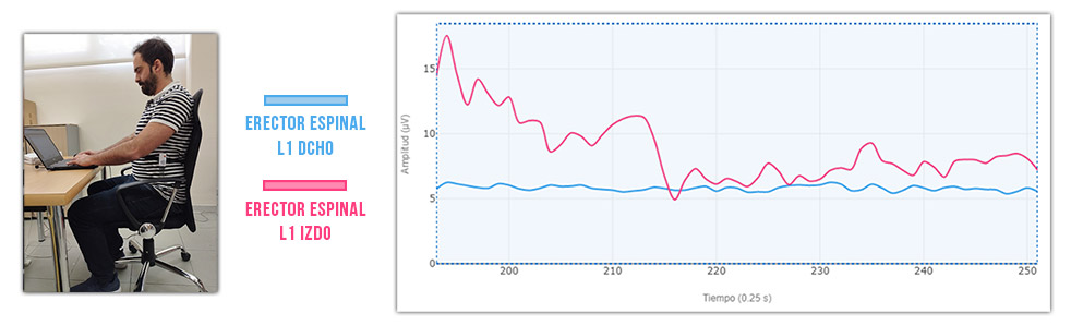 erector espinal izquierdo