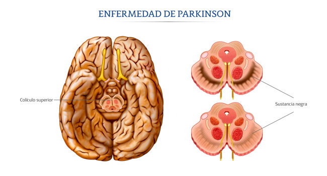 enfermedad de parkinson
