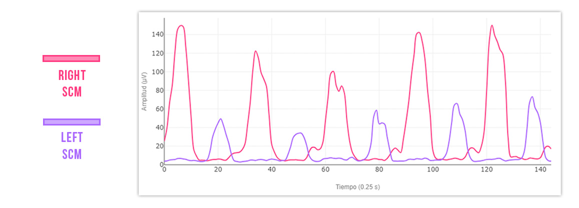 limited cervical rotation