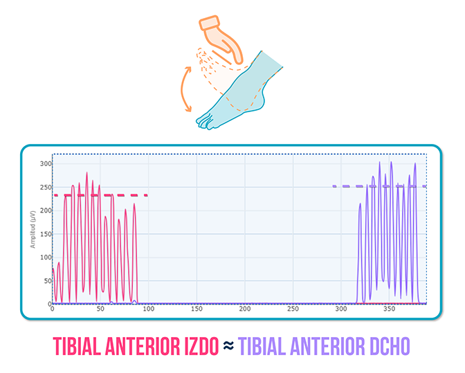Tendinopatía del Tibial anterior