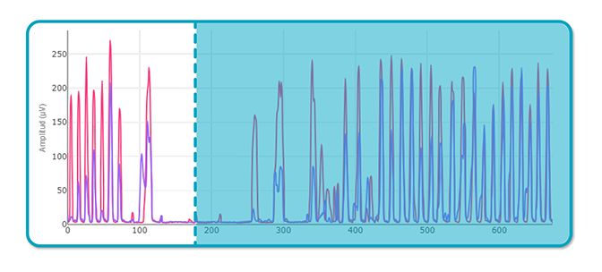 Tendinopatía del Tibial anterior
