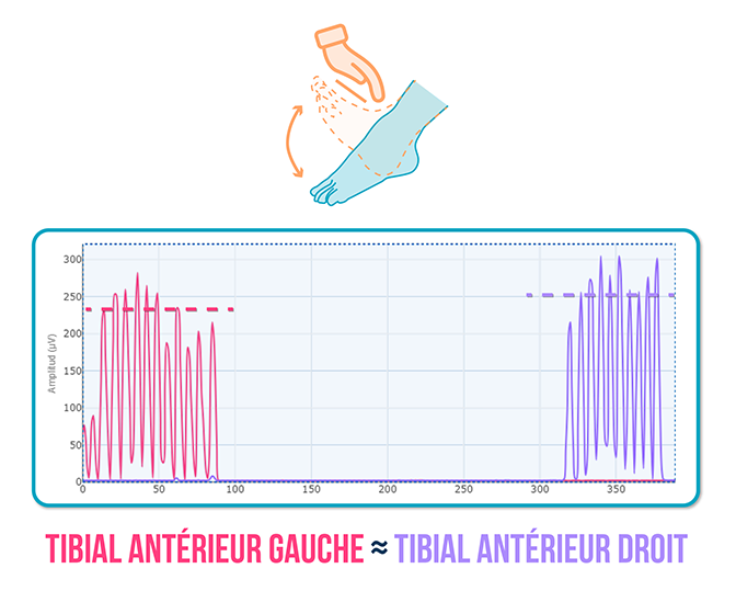 Tendinopathie du tibial antérieur
