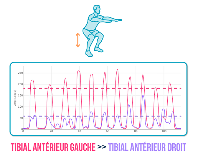 Tendinopathie du tibial antérieur