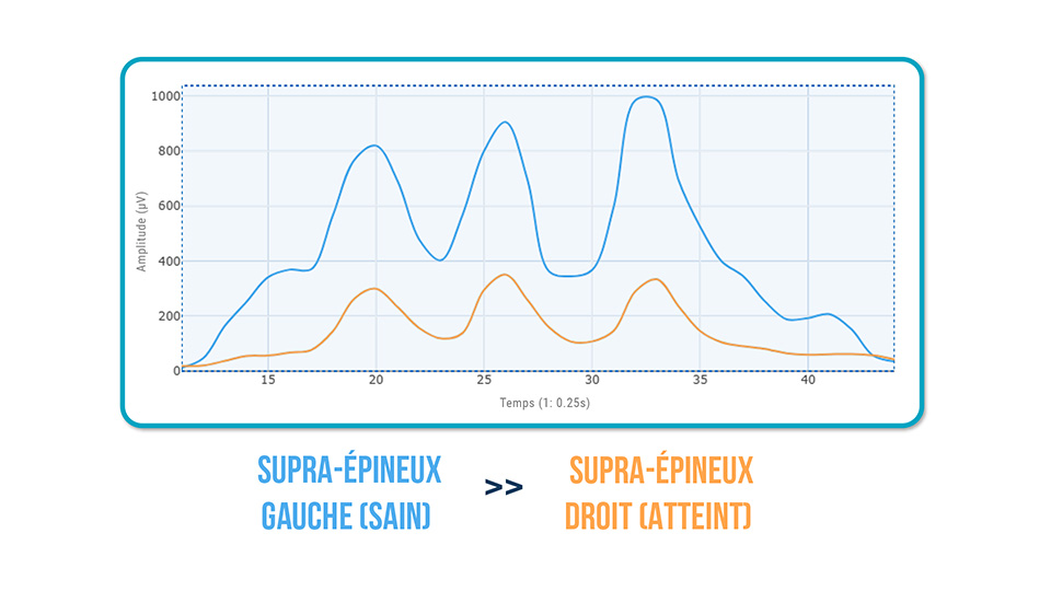 patients atteints de tendinopathie
