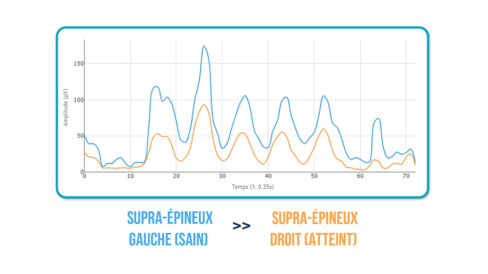 patients atteints de tendinopathie
