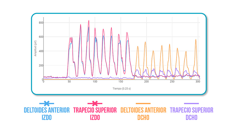subacromial syndrome