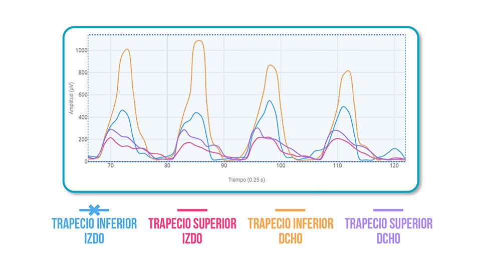 síndrome subacromial