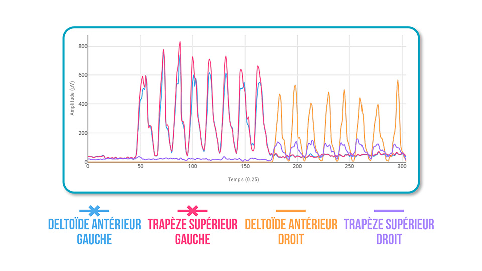 syndrome subacromial