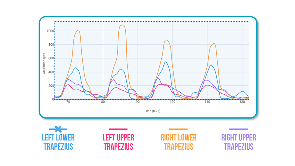 subacromial syndrome